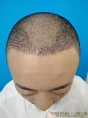 头发种植手术：植发的治疗效果如何？有哪些注意事项？